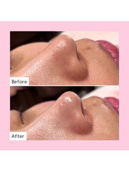 ホワイトラボ ライカム前店(White labo)/【施術例】毛穴洗浄ピーリング