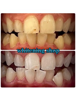 ホワイトニングショップ 福島店(WHITENINGSHOP)/初めてのホワイトニング歓迎♪