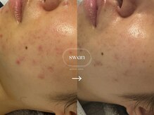 スワン 大阪南堀江(swan)/お肌の赤み、ニキビにお悩みの方
