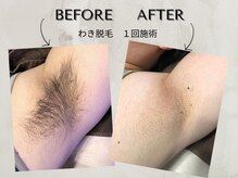 ワンアップ(One-up)/わき脱毛 １回　before after