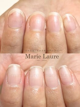 マリーロール 梅田店(Marie Laure)/深爪矯正/自爪育成/自爪風