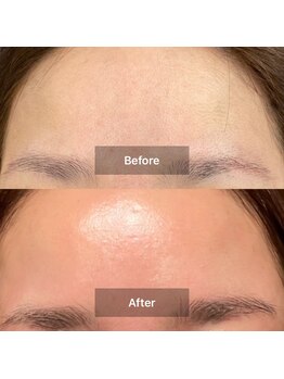 モカ 天王寺店(MOKA)/ツヤ肌 水光肌 乾燥 毛穴 ニキビ