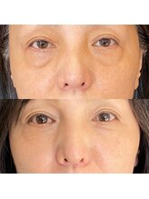 ウイユ(Oeil)/剥けるハーブピーリング 効果2回