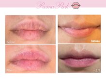 ビューティーリバース 新横浜店/ローマピンク_リップ施術例