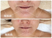 キーオブフェイス(Key of Face)/お悩み【顔全体小さくしたい】