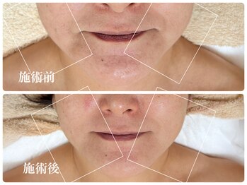 キーオブフェイス(Key of Face)/お悩み【顔全体小さくしたい】