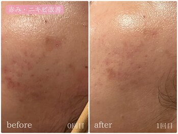 テン(10ten)/赤み・ニキビ改善