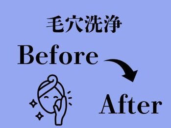 ビースキン 広島(BE:SKIN)/毛穴洗浄/黒ずみ/開き/くすみ