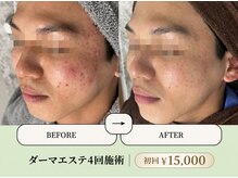 ベネミー 恵比寿(Benemi)の雰囲気（しぶといニキビケアには、ダーマエステがおすすめ！初回￥15,000）