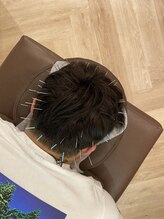 ウル鍼灸整骨院/ヘッド鍼