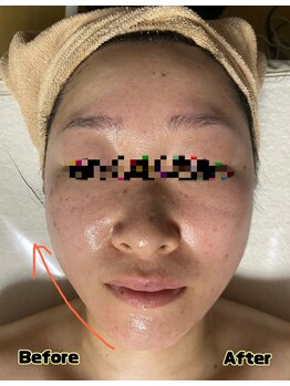 エビアス(Ebias)/引き上げの効果