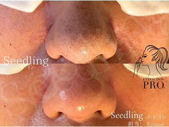 シードリン(Seedling)/毛穴エクストラクションプロ