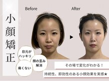 人気No.1★写真に写る自分が変わる！新感覚小顔矯正♪