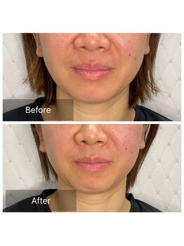 カドル 新宿店(KADORU)/小顔矯正+美容機器 Before-After