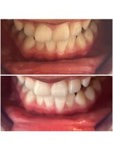 エクシアホワイトニング 代々木店/ホワイトニングビフォーアフター