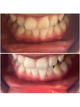 エクシアホワイトニング 代々木店/ホワイトニングビフォーアフター