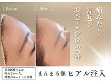 小顔・美肌専門 クリニカルサロン Nurse Reface 【ナースリフェイス】の雰囲気(まんまるふっくらおでこ♪おでこのシワも改善!)