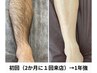 【人気No.2/メンズクーポン】痛みの少ない膝上下＋脇 脱毛1回¥15000→¥10500