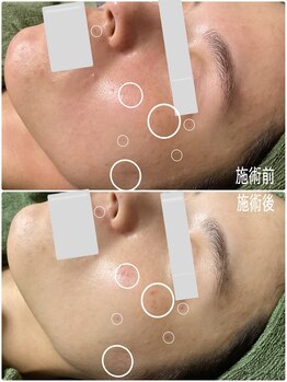 ブライトリー(Brightly)/最新光エステ1回でこの透明感!