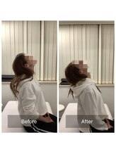 ナオル整体 新宿院(NAORU整体)/20代女性-猫背矯正Before/After