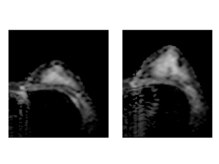 エミュボディ 青山本店(emu body)/症例写真 ビフォーアフター MRI