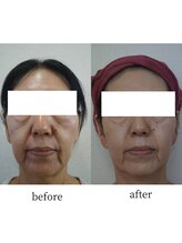 アップルミント/＜フェイシャル＞before・after