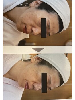 メディカルサロン フィオレ(fiore)/パワーライトフェイシャル