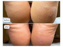 カシェット(Cachette)/60代男性◎足裏角質ケア90分