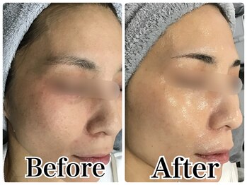 ルリアン(LeLien)/ダクトピール＋LDM 5回の効果！