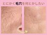 【毛穴】開き毛穴、いちご鼻、凸凹毛穴を本気で改善したい方 初回体験