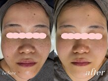 ミウル 天王寺店(miulu)/30代女性/シミ照射2回