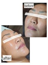 アースコアフュールボーテ ひたち野うしく店(EARTH coiffure beaute)/光フェイシャル 6回の結果