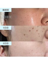 リシェル(Richelle)/【WHITELAB☆はがれるシミケア】