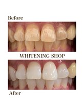 ホワイトニングショップ 徳島藍住店/Before After美白ホワイトニング