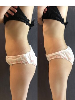 ナラビューティー(NARA BEAUTY)/◇輪郭リフト一回の効果 ◇