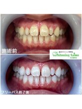 ホワイトニングサロン 名古屋駅店/【ホワイトニング施術例】