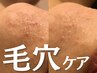 【当店人気NO,1】毛穴改善ハーブピーリング+IPSP幹細胞導入 ¥16,500