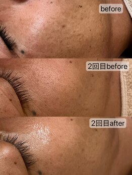 フェリノ(FERINO)/エクソソームハーブピーリング