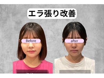 プライミー(PRIMY)/エラ張り改善