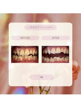 プラスビー 2号店(+b)/ホワイトニングビフォーアフター