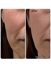 ラナン(ranan)/贅沢フェイシャル