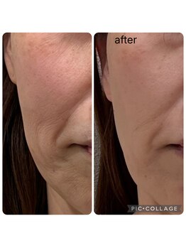 ラナン(ranan)/贅沢フェイシャル