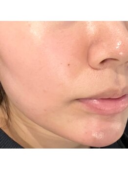 レプス(Lepus)/24時間ハーブピーリング