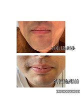 レイモード(Ray mode)/ヒゲ脱毛