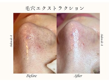 サロンドエー 帝塚山(Salon de A)/毛穴洗浄【毛穴ケア】!