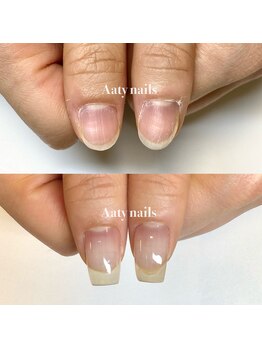 ハンド深爪矯正