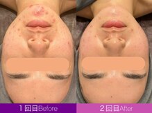 クレヴィア バイ サイバーエステ(CREBIA)/CHRISTINA【ハーブピーリング】