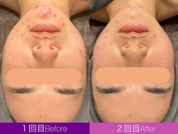 クレヴィア バイ サイバーエステ(CREBIA)/CHRISTINA【ハーブピーリング】