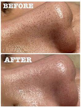 アンドエルビオ(&Elbio)/毛穴洗浄