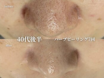 コウル 川西能勢口店(geoul)/肌質改善コース